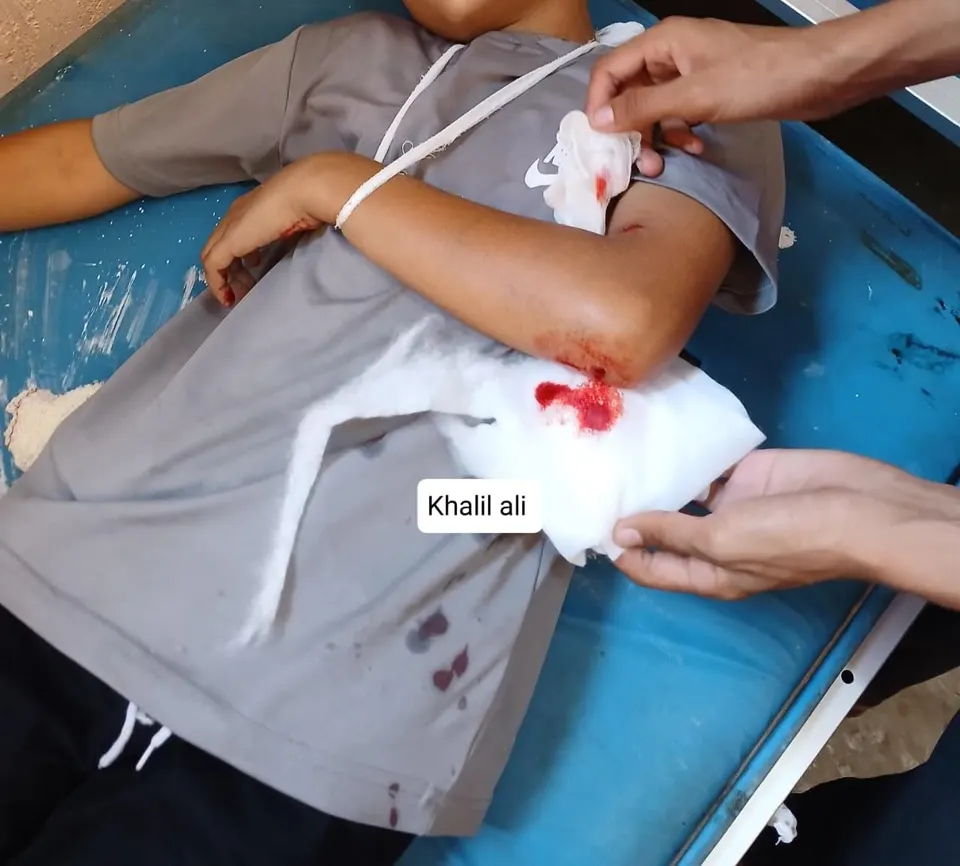 Child injured by occupation gunfire while carrying water at his displacement site at Abdel Qader Al-Husseini School near Nasser Medical Complex west of Khan Younis. — Image 1